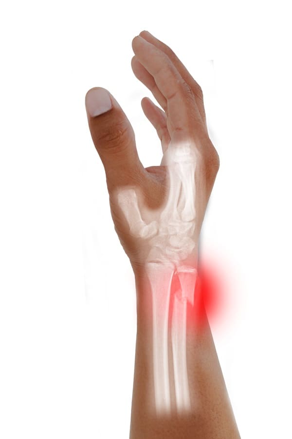 clinica-para-fracturas-de-radio-y-cubito-en-cdmx.jpg