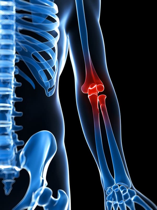 precio-de-la-cirugia-de-fracturas-de-codo-en-cdmx.jpg