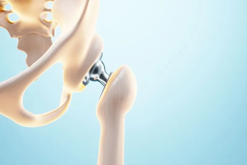 Prótesis de cadera ofrecido por Dr. Luis Daniel Ramos Montes que es especialista en Ortopedia y Traumatología